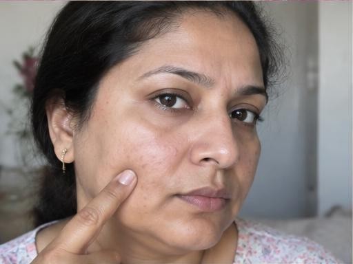 Acne & Blemishes